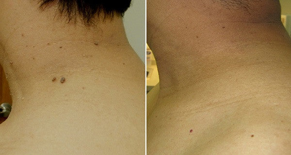 Tea Tree Essential Oil